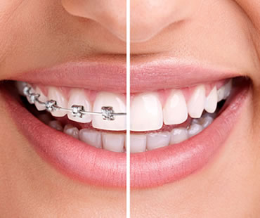 Private: Advantages of Invisalign