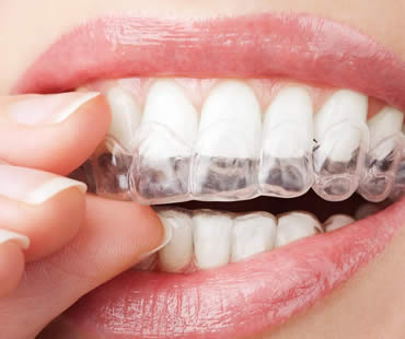 Invisalign: Straightening Teeth Without Braces