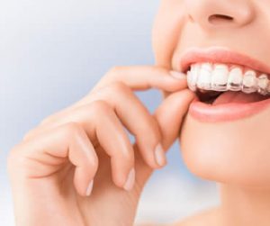 Private: Keep Your Mouth Healthier by Choosing Invisalign Over Traditional Braces