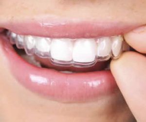 Private: Invisalign and Older Smiles