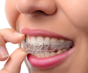 Should My Teen Choose Invisalign or Traditional Braces