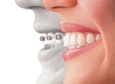 Private: Opting for Invisalign